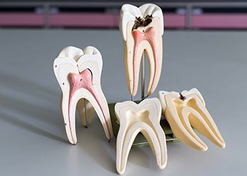 Models of the inside of healthy and unhealthy teeth