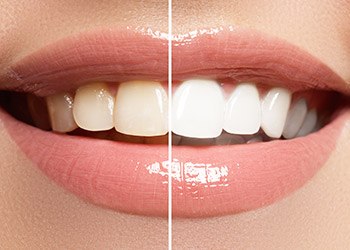 Smile before and after teeth whitening