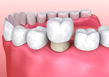 Animation of dental crown placement