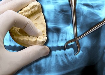 Model and x-ray of tooth to be extracted
