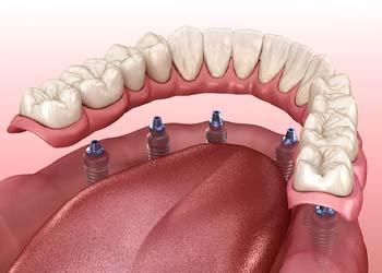 Implant dentures in Cumberland