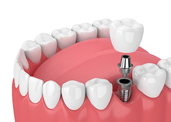 Diagram of a single tooth dental implant in Cumberland