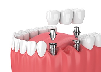 Diagram showing implant bridge replacing multiple missing teeth in Cumberland