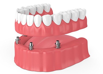 Diagram showing how implant dentures work