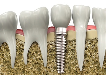 Diagram showing dental implant in Cumberland during osseointegration