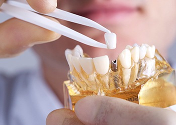 Dentist holding restoration and model jaw with implants