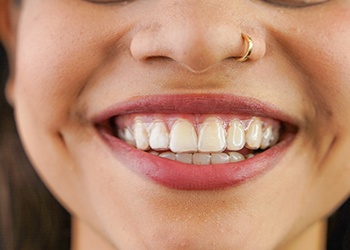 Closeup of smiling patient wearing Invisalign aligner