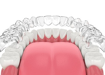 Illustration of Invisalign aligner being placed on bottom row of teeth
