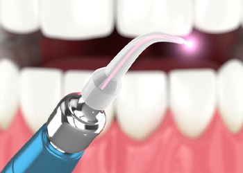 Illustration of laser in front of open mouth