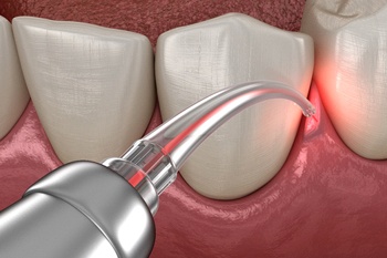 Illustration of Laser Dentistry in Cumberland being used on gums
