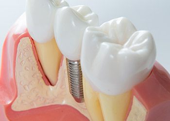 Model smile with implant supported dental crown