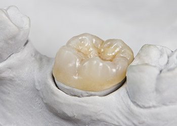 Model smile with dental crown