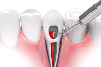 root canal therapy in Cumberland