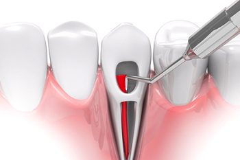 root canal diagram