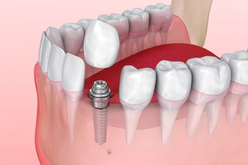single tooth implant