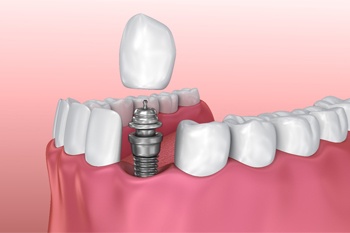 dental implant