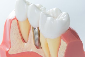model of dental implant