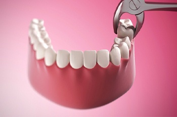 model of tooth being removed