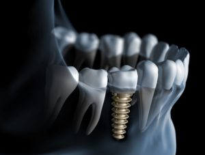 Dental Implant in jaw